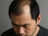 아시아 면역세포 지도 완성…韓 원형탈모 높아